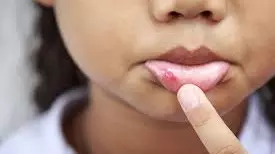 ये घरेलु चीजें दिलाएंगी मुंह के छाले से राहत