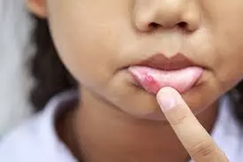 ये घरेलु चीजें दिलाएंगी मुंह के छाले से राहत