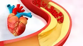 कलेस्ट्रोल कम करने के लिए हैं परेशान, इन बातों पर दें ध्यान