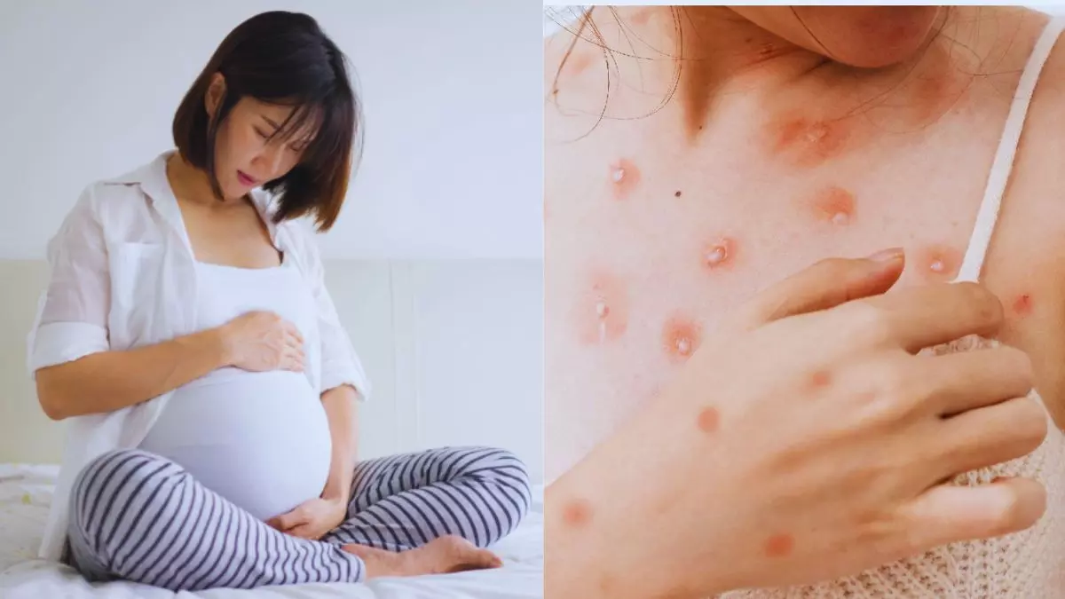 Mpox in India : भारत में गर्भवती महिलाओं को बरतनी होगीं ये सावधानियां, नहीं तो हो सकती हैं ये समस्याएं Mpox in India : भारत में गर्भवती महिलाओं को बरतनी होगीं ये सावधानियां, नहीं तो हो सकती हैं ये समस्याएं