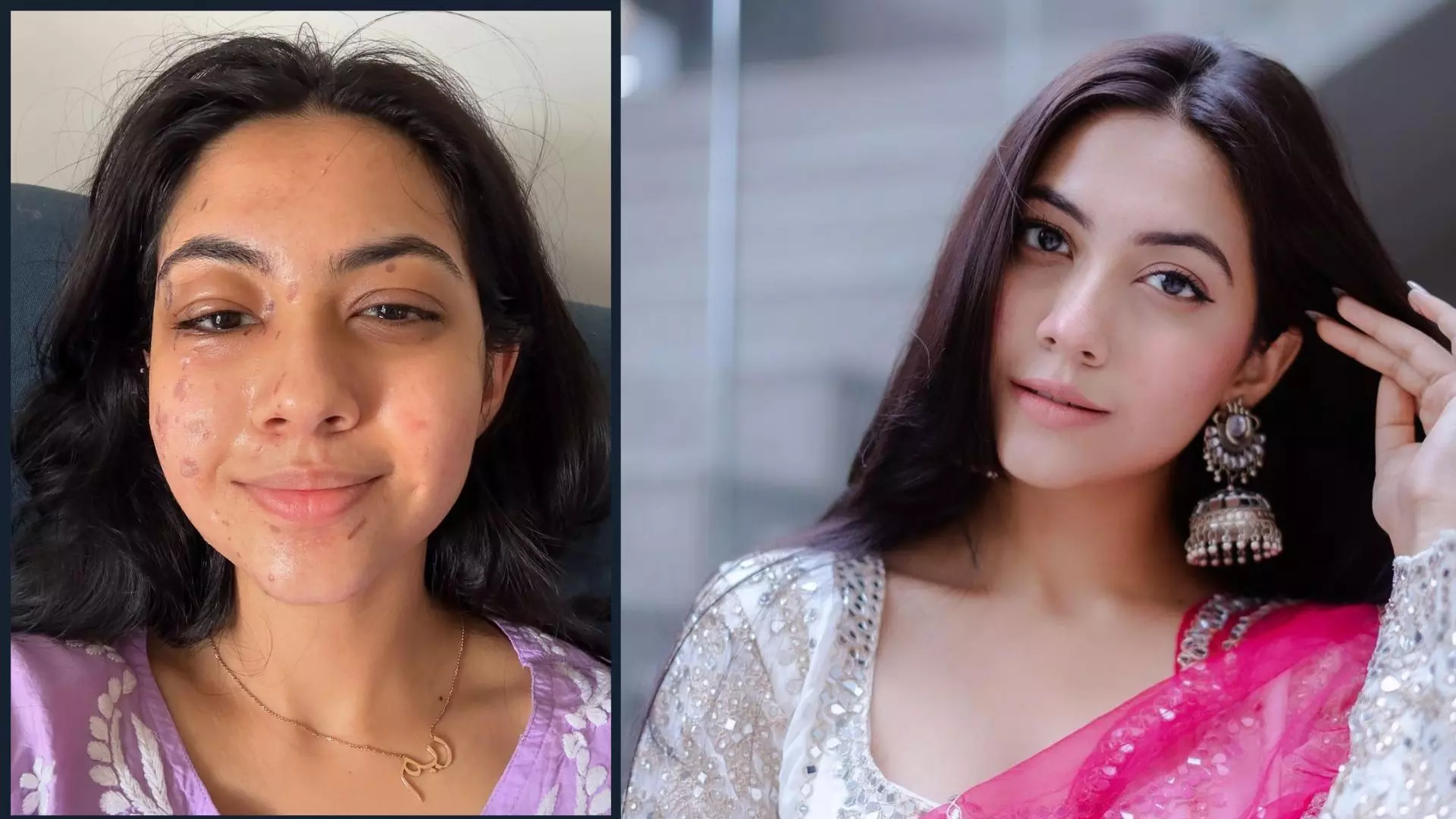 Laughter Chefs के सेट पर Reem Shaikh के चेहरे पर पड़े थें गर्म तेल के छीटें, अब रिकवर कर रही हैं एक्ट्रेस