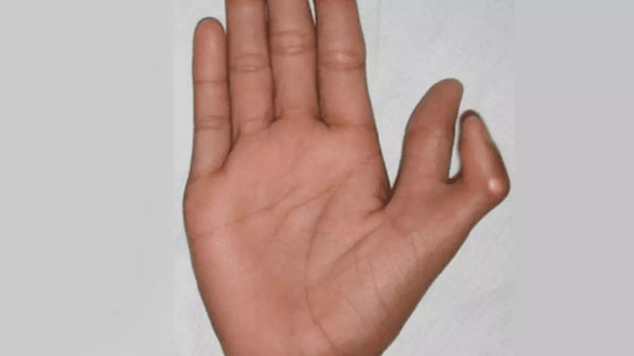 क्या आपके हाथ में हैं 6 उंगलियां? जानें क्यों ऐसे लोग होते हैं बेहद लकी