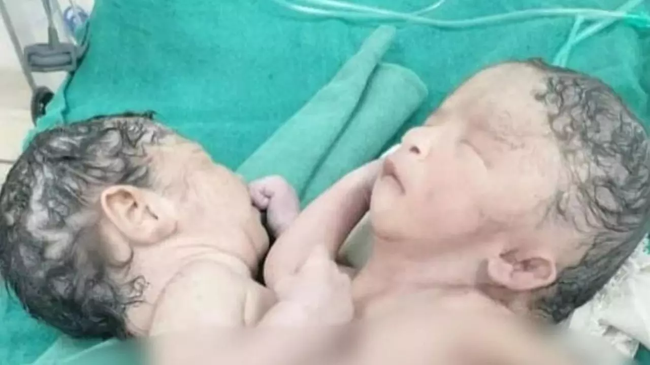 मध्य प्रदेश में एक दिल के साथ पैदा हुआ जुड़वा बच्चा, शरीर से जुड़े हैं चार हाथ, चार पैर और दो सिर