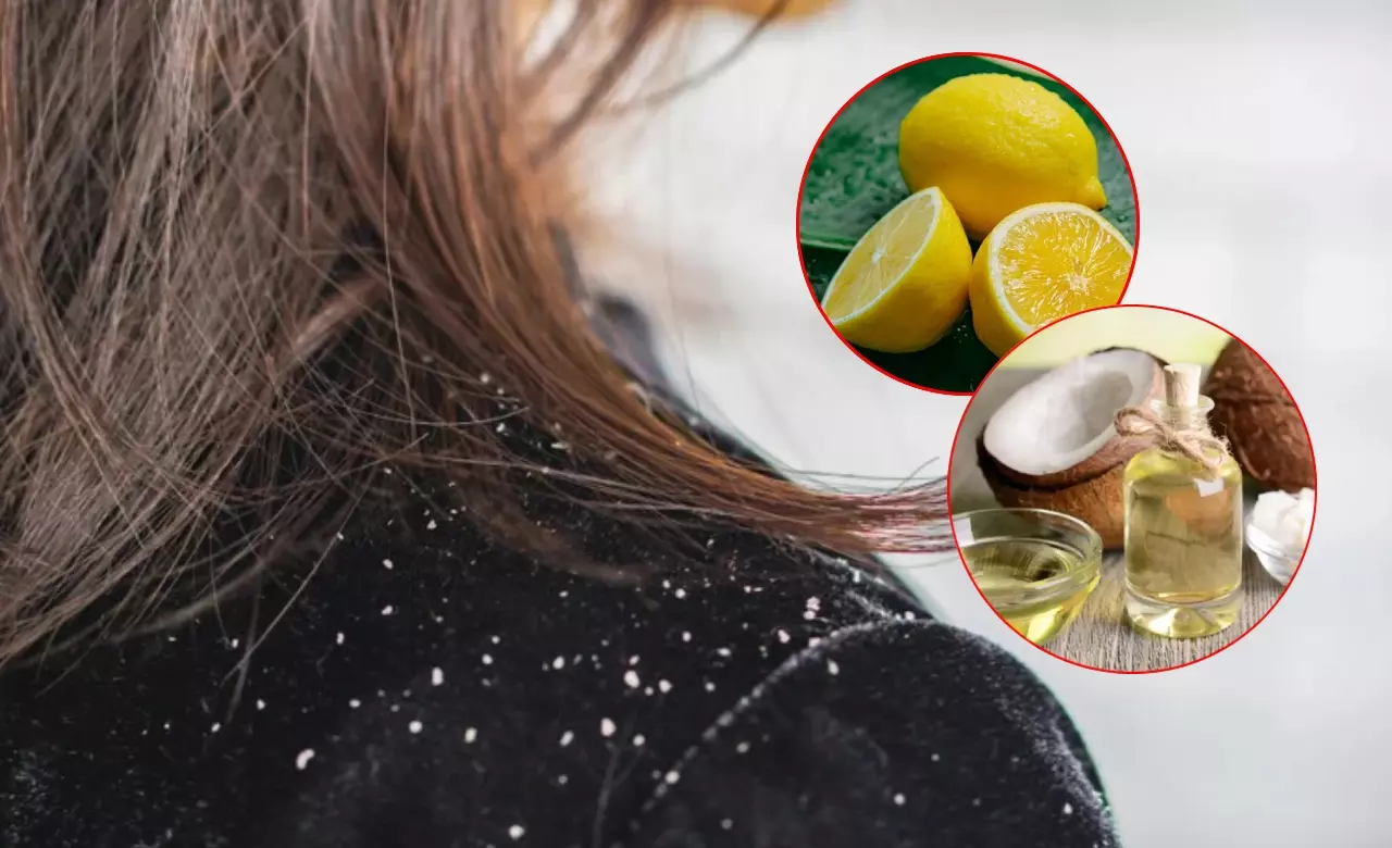 सर्दियों में बढ़ सकती है डैंड्रफ की समस्या, अपनाएं ये उपाय मिलेगा आराम