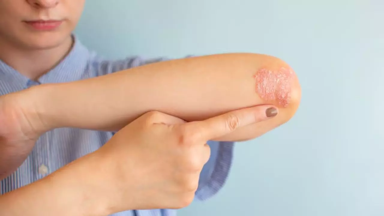 क्या है Atopic Dermatitis, स्किन पर हो रही है खुजली तो हो जाएं सावधान? क्या है Atopic Dermatitis, स्किन पर हो रही है खुजली तो हो जाएं सावधान?