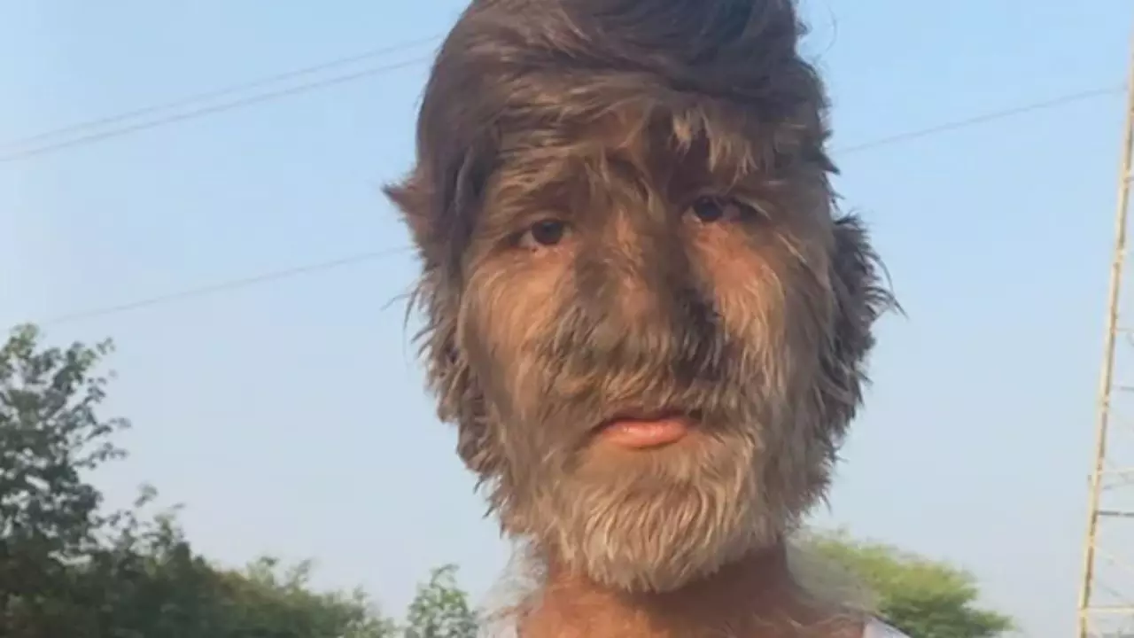 सिर से ज्यादा चेहरे पर बाल, गिनीज बुक में दर्ज हुआ नाम, जानें क्या है Werewolf Syndrome