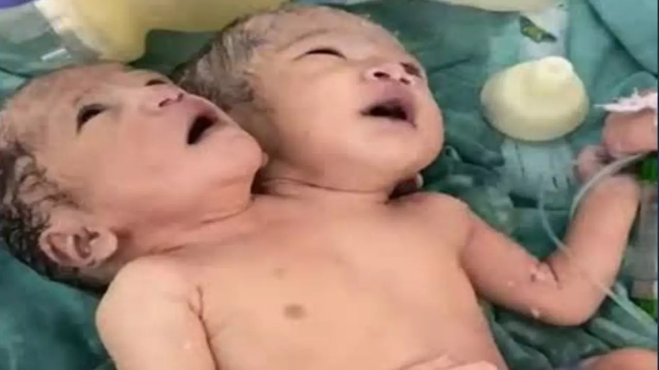 इंदौर में जन्मी दुर्लभ बच्ची, दो सिर, एक धड़ और दो लिवर... ऑपरेट कर अलग क्यों करना चाहते हैं डॉक्टर्स?