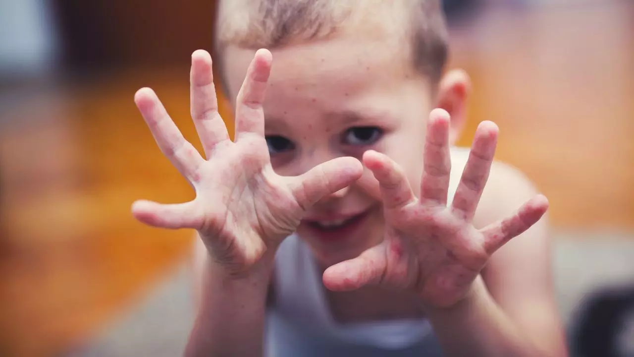 Hand, foot & mouth disease: हाथ-पैर-मुंह में दाने, बच्चे बेचैन... जानें कैसी है ये रहस्यमयी बीमारी?