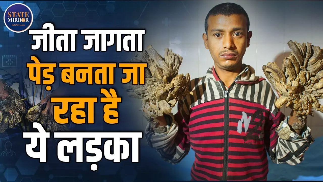 Tree Man Disease: इस शख्‍स को हुई दुर्लभ बीमारी, पेड़ जैसा बनता जा रहा पूरा शरीर - Video