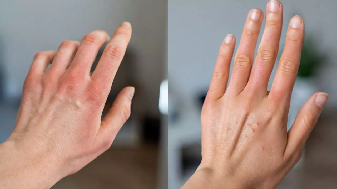 मंकीपॉक्स के मरीजों का मुफ्त इलाज करेगी इस राज्य की सरकार, जानें कब तक मिलेगी वैक्सीन