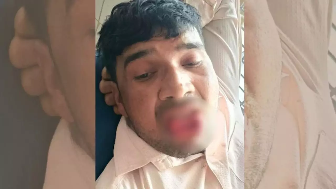 शादीशुदा युवक Ex Girlfriend को जबरन कर रहा था KISS, युवती ने काट ली जीभ, पुलिस ने दर्ज मामला किया