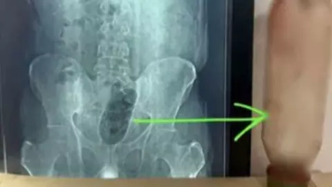 Agra Shocking Case: युवक ने प्राइवेट पार्ट में डाली 1 लीटर पानी की बोतल, 90 मिनट की सर्जरी के बाद हुआ चौंकाने वाला खुलासा Agra Shocking Case: युवक ने प्राइवेट पार्ट में डाली 1 लीटर पानी की बोतल, 90 मिनट की सर्जरी के बाद हुआ चौंकाने वाला खुलासा